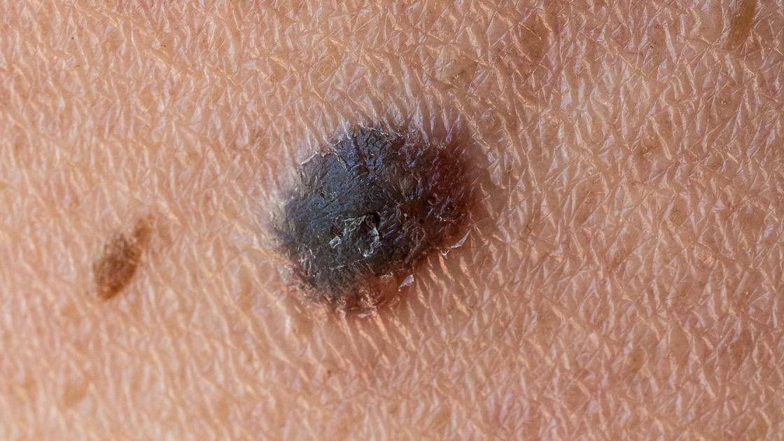 Moderna-Merck mRNA Vaccine Cuts Melanoma Recurrence Risk by 42%