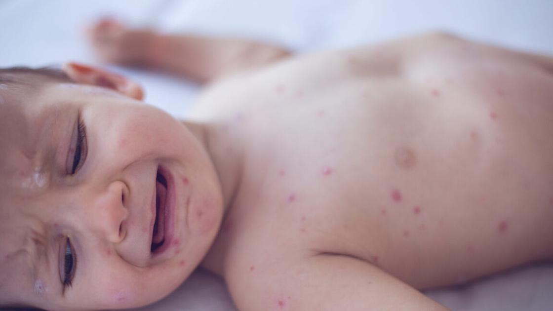 Pennsylvania coroner confirms measles caused infant death amid dispute