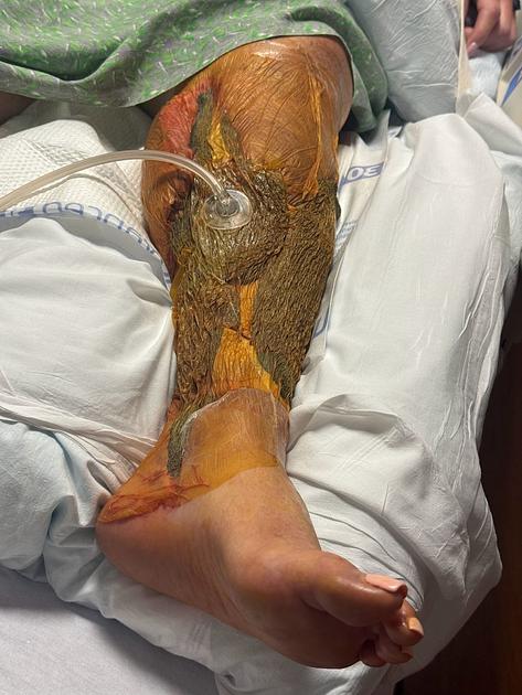 Florida Health Department Confirms 22 Vibrio Cases and Four Deaths