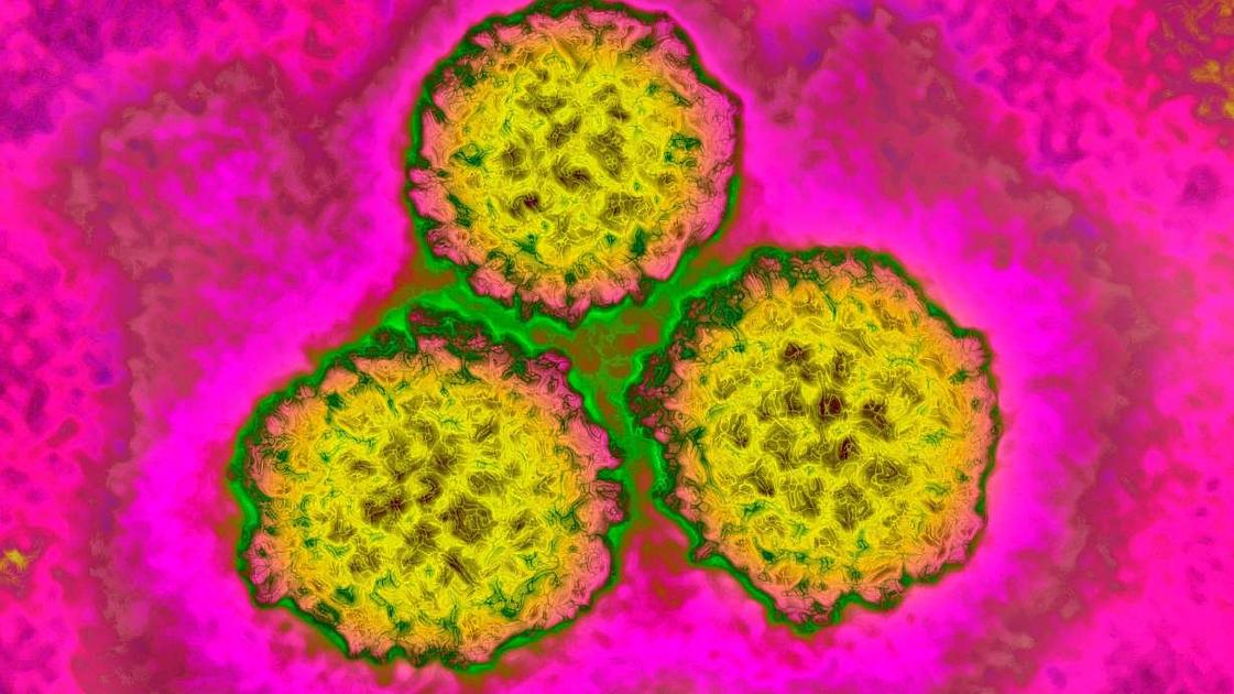Study Links About One Eighth of 2024 Cancer Cases to Preventable Infections
